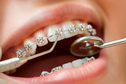 東京のガミースマイル治療でおすすめの治療法⑧インプラント矯正